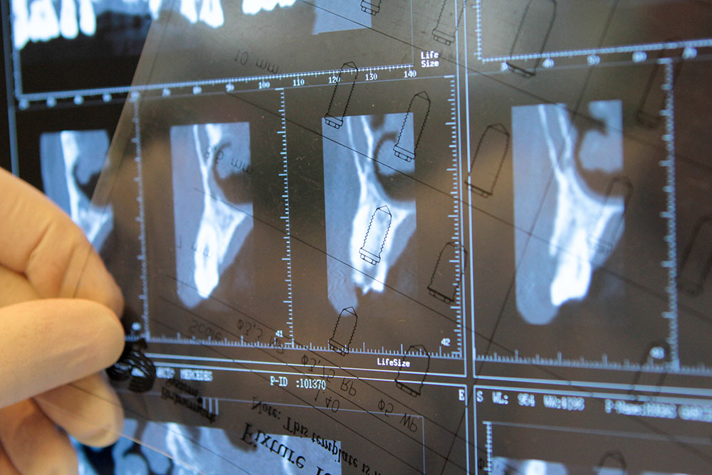 Implantes Dentales